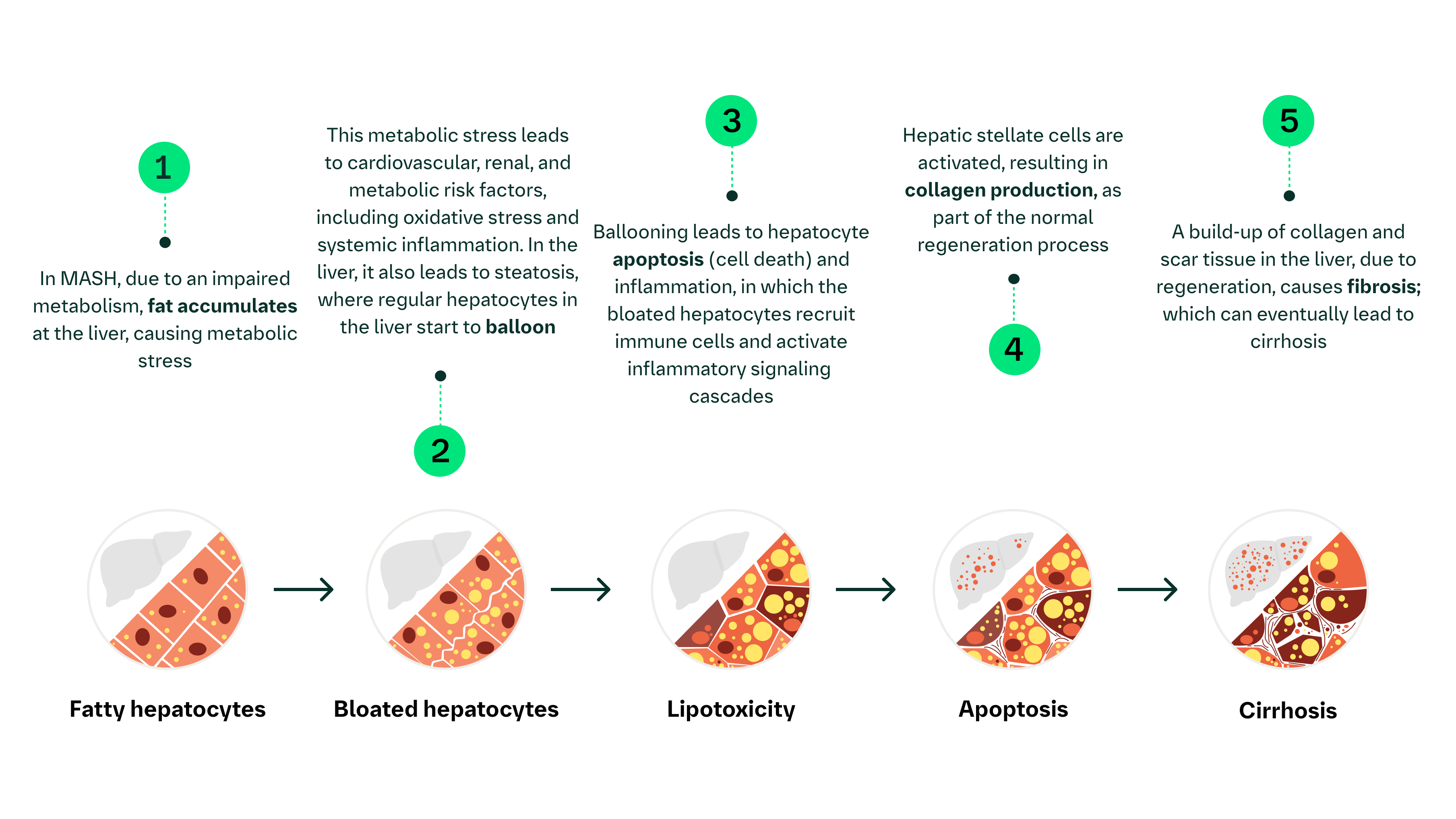 MASLD and MASH Explained | Boehringer Ingelheim